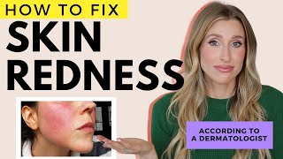 Fix Redness on the Face and Body  Dr Sam Ellis [upl. by Nicolau]