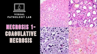 NECROSIS part1 COAGULATIVE NECROSIS [upl. by Lehteb705]