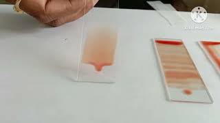 Mistakes BloodSmearPreparation HaematologyPractical Demonstration [upl. by Yadsendew]