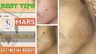 BEST TIPS FOR BEARD GROWTH  More follicles  Get initial boost  Beard growth result before amp after [upl. by Dincolo]