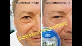 Tränensäcke geschwollene Augen Augenringe in 3 Minuten wegbekommen die Soforthilfe [upl. by Celin]