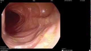 G EYE Colonoscopy [upl. by Adnerol103]