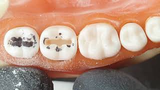 Cavidades dentales según Black OdontologíadelSigloXXI [upl. by Daley]