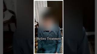 SLP Dr Nasir Khan Puberphonia treatment in Pakistan Prepost By voice therapy without pain [upl. by Eiralih]