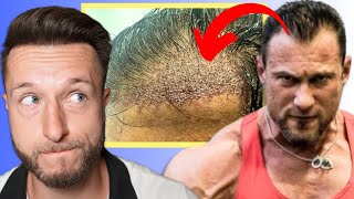 Tony Huge had a hair transplant My thoughts Full Uncut Video [upl. by Courtland]