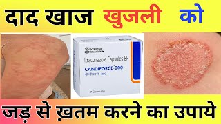 Candiforce 200 Capsule Uses  Khujli Ka Permanent Ilaj [upl. by Ashia]