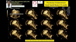 Penebalan Endometrium 45 weeks [upl. by Daisey]