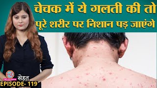 Chicken Pox जिसे माता निकलना कहते हैं उसे लेकर बड़ी ग़लतफ़हमी दूर कर लीजिए  चेचक  Sehat ep 119 [upl. by Navar]