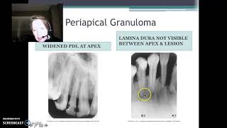 Periapical Radiolucency amp Radiopacity [upl. by Guinevere]