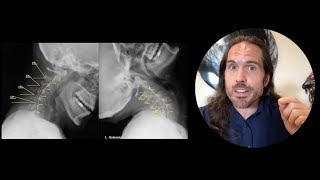 Cervical Instability Dizziness amp Headaches Do I need injections Chiropractor Spokane [upl. by Verlie]