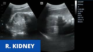 Acute Pyelonephritis  Ultrasound Case [upl. by Anoyek728]