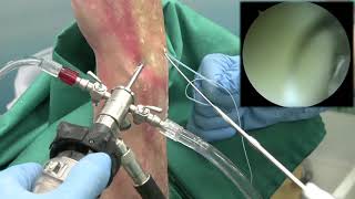 Indirect Scapholunate Ligament Repair All Arthroscopic [upl. by Vorster]