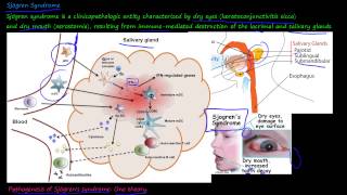 101P  What is Sjögren Syndrome [upl. by Torrance939]