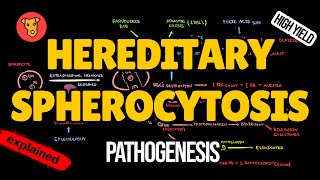 HEREDITARY SPHEROCYTOSIS Pathogenesis Clinical Symptoms Treatment [upl. by Llorre]