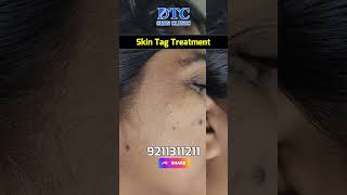 Face Skin Tag Removal Treatment [upl. by Relyat]