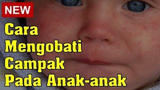 Cara Mengobati Campak Pada Anak [upl. by Aihsital]