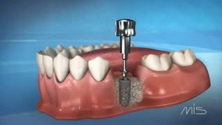 Clínica de implantes dentales en BogotáMarlon Becerra Niza [upl. by Nelav]