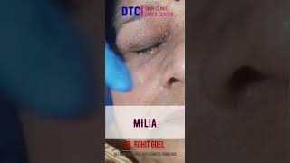 Milia extractionDr Rohit Goel [upl. by Beore108]