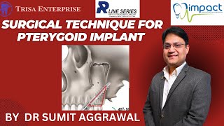 SURGICAL TECHNIQUE FOR PTERYGOID IMPLANT  BY DR SUMIT AGGRAWAL  part 1 [upl. by Sedicla]