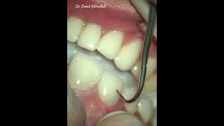 Veneer removal [upl. by Silloc]