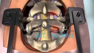 3D Medical Animation  Lumbar spine surgical procedure 2 level fusion of L4S1 [upl. by Tate]