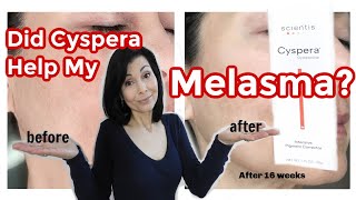 Did Cyspera® Help My Melasma My Results [upl. by Foote]