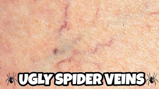 Sclerotherapy for the treatment of Spider Veins [upl. by Esilram671]