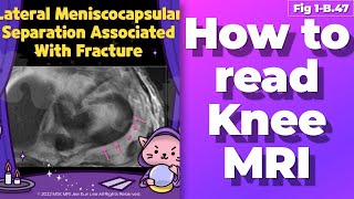 Fig 1B47 Lateral meniscocapsular separation associated with fracture [upl. by Mitinger758]