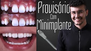 Dente provisório com Minimplante Ortodôntico Como fazer [upl. by Fini878]