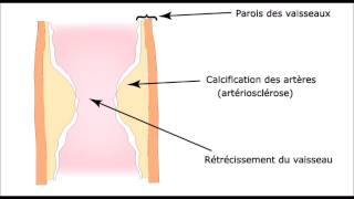 Calcification des artères artériosclérose [upl. by Agiaf957]