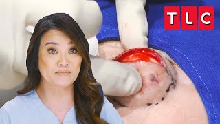 Dr Lee Squeezes “Devil Horn” Cyst off the Forehead of a Patient  Dr Pimple Popper  TLC [upl. by Fernas787]