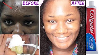 😱 I Applied toothpaste and vaseline on my face and See what happened the next day [upl. by Acirem]