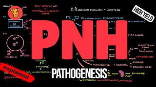 Paroxysmal Nocturnal Hemoglobinuria Pathogenesis Symptoms Diagnosis Treatment [upl. by Ahtela]