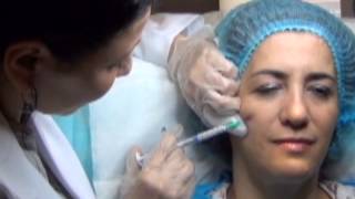 Fluid Facelift  with RADIESSE Dermal filler Demonstrated by Dr Nancy Labib [upl. by Lucinda787]