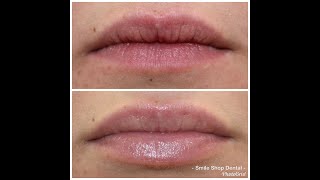 Lip Filler for a NATURAL LOOK with JUVÉDERM VOLBELLA® XC [upl. by Asiak]