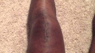 Week 3 Of Recovery of Ruptured Patella Knee Tendon [upl. by Erinna578]