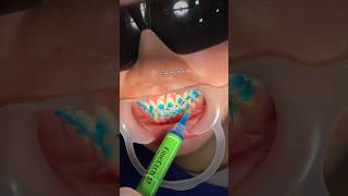 braces orthodontics dentist orthodontist teeth dental dentistry teethwhitening dentalcare [upl. by Idnic504]