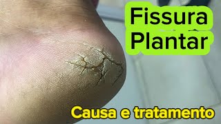 FISSURA PLANTAR COMO TRATAR Podóloga Priscila Rezende [upl. by Ennaeilsel]