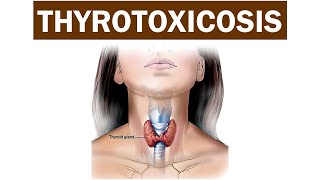 Thyrotoxicosis [upl. by Dex]