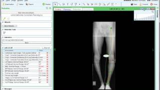 High Tibial Osteotomy HTO  Deformity Correction Planning  Materialise OrthoView [upl. by Pelag]