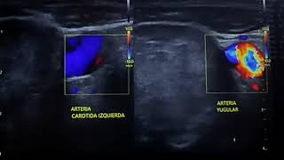 ULTRASONIDO DE GLÁNDULA TIROIDES CON BOCIO MICRONODULAR DIFUSO [upl. by Held]