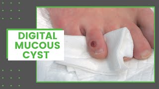 Digital Mucous Cyst  Dr Derm [upl. by Areval]