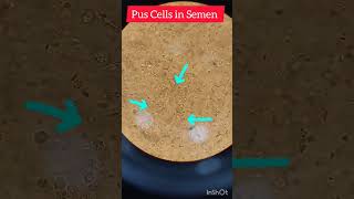 Semen examination under microscopeWBCsWhite Blood cells spermatozoasperm [upl. by Morentz554]