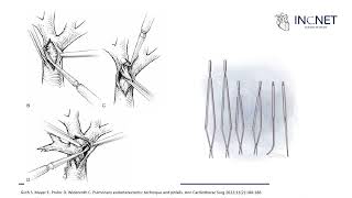 TROMBOEMBOLIA PULMONAR CRONICA TRATAMIENTO QUIRÚRGICO [upl. by Gerius262]