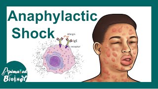 Anaphylactic shock  Anaphylactic Reaction Symptoms and Treatment [upl. by Lossa]