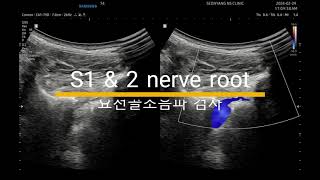 허리 골반 천장관절 통증 S1 and 2 nerve root [upl. by Rekrap]