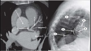 ChestampCardiac Radiologyanatomy3with answers CTMRIchestxrayfrcrquiezrdaiopediatipsexams [upl. by Dallman]