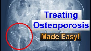 OSTEOPOROSIS Medications Made EASY [upl. by Anne-Corinne]