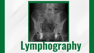 Lymphography Lymphangiography Techniques And Uses Lymphangiogram Purpose Procedure And Risks [upl. by Melena]