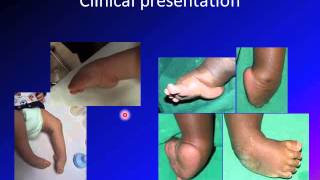 clubfoot  talipes equinovarus  TEV [upl. by Tnilc]